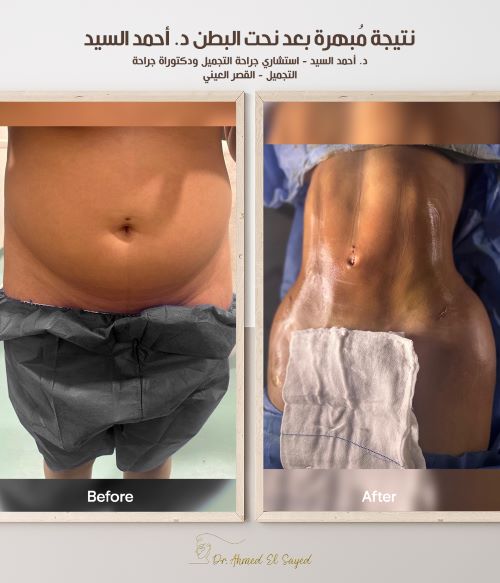 افضل دكتور نحت البطن
